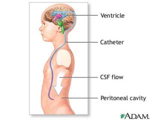 Ventriculoperitoneal Shunt (VP Shunt)