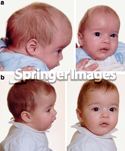 Scaphocephaly Before/After