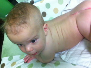 Colten Spina Bifida Myelomeningocele Scar