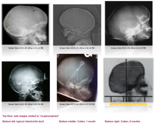 Comparison of various images found online, noting scaphocephaly occurrances and a typical skull. Includes a 1 month and 8 month scan of Colten.